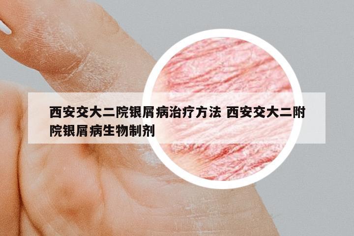 西安交大二院銀屑病治療方法 西安交大二附院銀屑病生物制劑