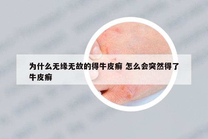 為什么無緣無故的得牛皮癬 怎么會(huì)突然得了牛皮癬