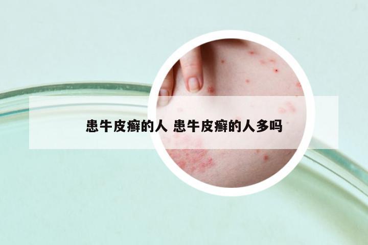 患牛皮癬的人 患牛皮癬的人多嗎