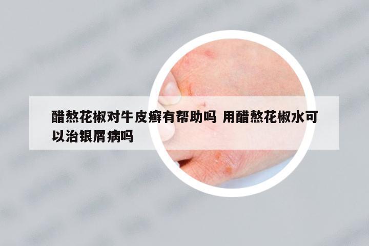 醋熬花椒對(duì)牛皮癬有幫助嗎 用醋熬花椒水可以治銀屑病嗎