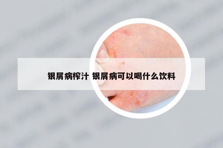 銀屑病榨汁 銀屑病可以喝什么飲料