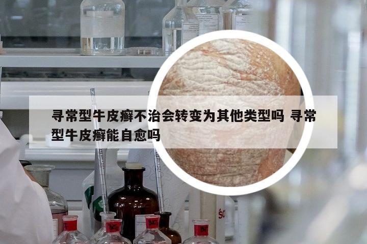 尋常型牛皮癬不治會(huì)轉(zhuǎn)變?yōu)槠渌愋蛦?尋常型牛皮癬能自愈嗎