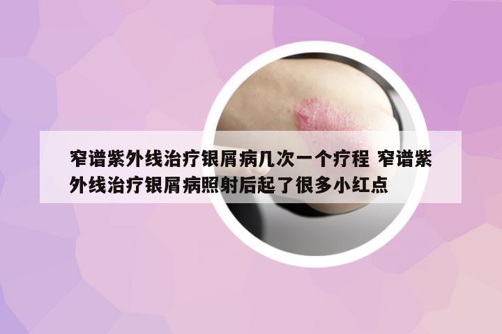 窄譜紫外線治療銀屑病幾次一個(gè)療程 窄譜紫外線治療銀屑病照射后起了很多小紅點(diǎn)