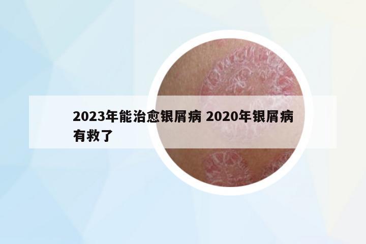 2023年能治愈銀屑病 2020年銀屑病有救了