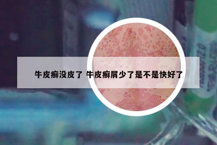 牛皮癬沒皮了 牛皮癬屑少了是不是快好了