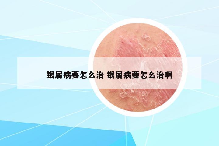 銀屑病要怎么治 銀屑病要怎么治啊