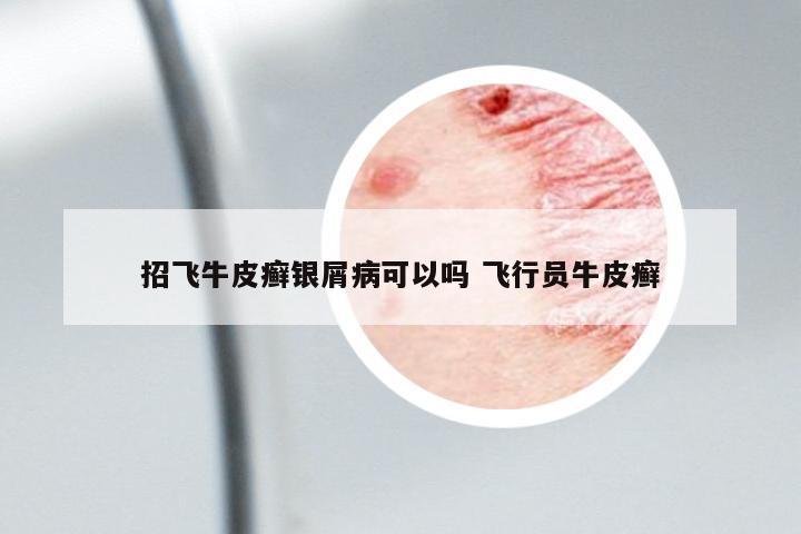 招飛牛皮癬銀屑病可以嗎 飛行員牛皮癬
