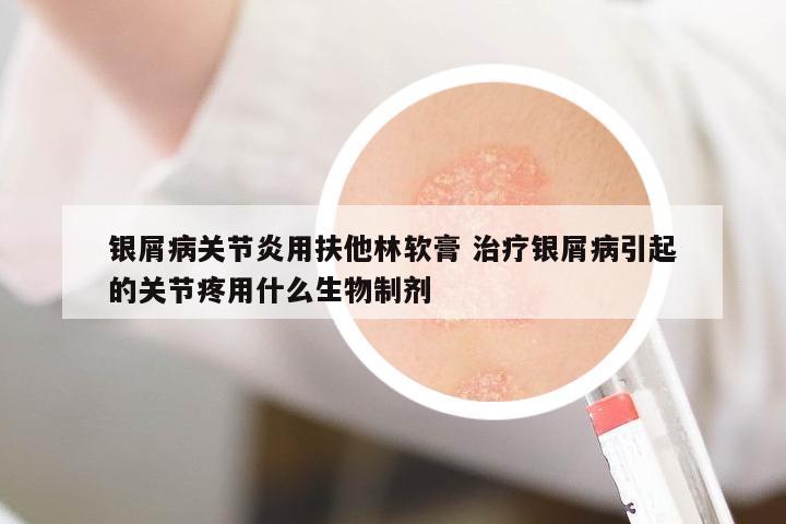 銀屑病關節(jié)炎用扶他林軟膏 治療銀屑病引起的關節(jié)疼用什么生物制劑