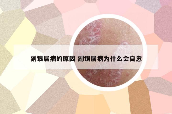 副銀屑病的原因 副銀屑病為什么會(huì)自愈
