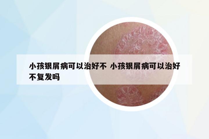 小孩銀屑病可以治好不 小孩銀屑病可以治好不復(fù)發(fā)嗎