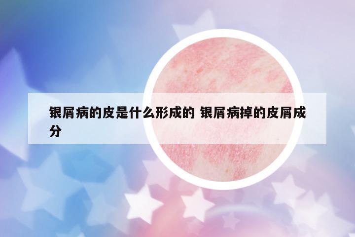 銀屑病的皮是什么形成的 銀屑病掉的皮屑成分