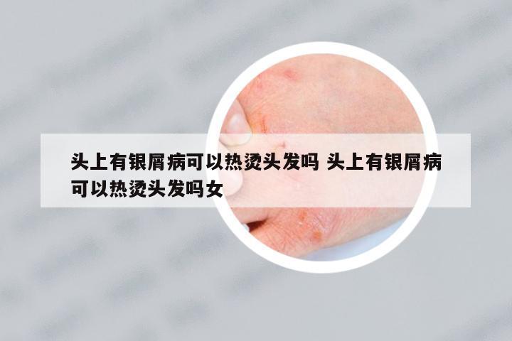 頭上有銀屑病可以熱燙頭發(fā)嗎 頭上有銀屑病可以熱燙頭發(fā)嗎女