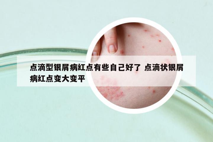 點滴型銀屑病紅點有些自己好了 點滴狀銀屑病紅點變大變平