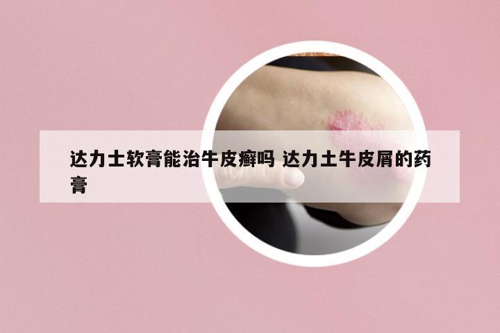 達(dá)力士軟膏能治牛皮癬嗎 達(dá)力土牛皮屑的藥膏