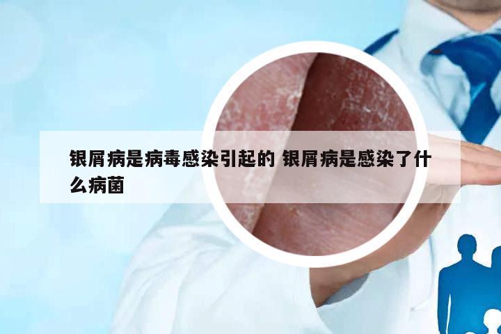 銀屑病是病毒感染引起的 銀屑病是感染了什么病菌