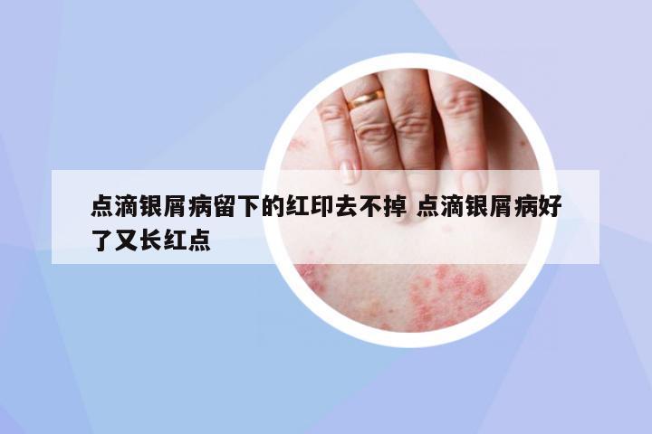 點滴銀屑病留下的紅印去不掉 點滴銀屑病好了又長紅點
