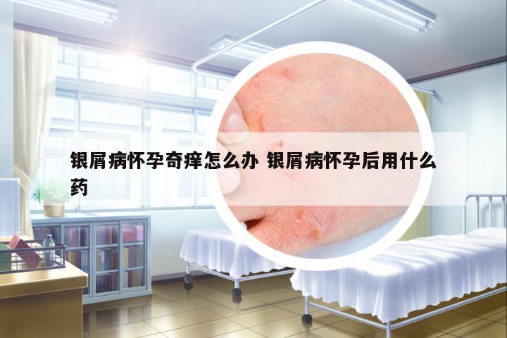 銀屑病懷孕奇癢怎么辦 銀屑病懷孕后用什么藥