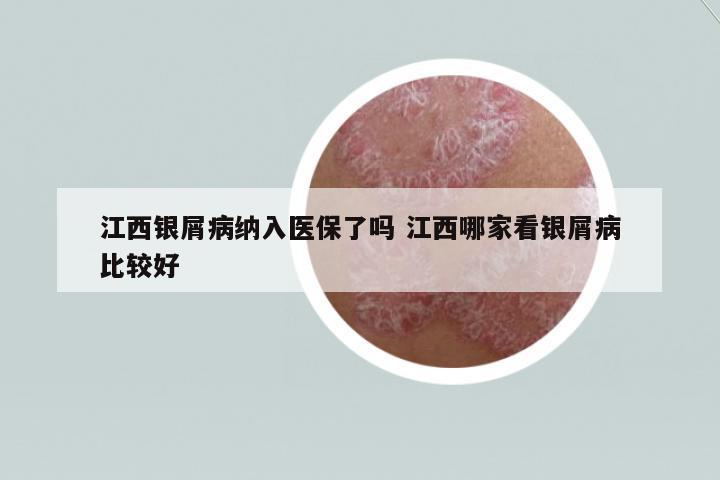 江西銀屑病納入醫(yī)保了嗎 江西哪家看銀屑病比較好