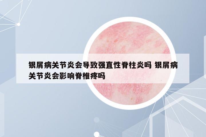 銀屑病關(guān)節(jié)炎會(huì)導(dǎo)致強(qiáng)直性脊柱炎嗎 銀屑病關(guān)節(jié)炎會(huì)影響脊椎疼嗎