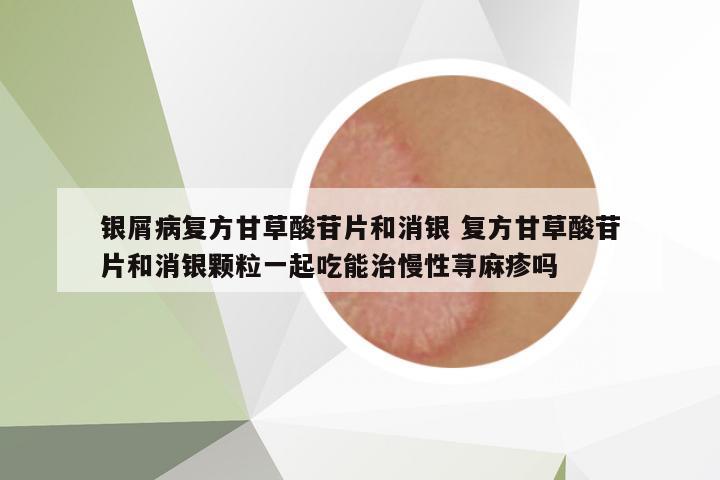 銀屑病復(fù)方甘草酸苷片和消銀 復(fù)方甘草酸苷片和消銀顆粒一起吃能治慢性蕁麻疹嗎