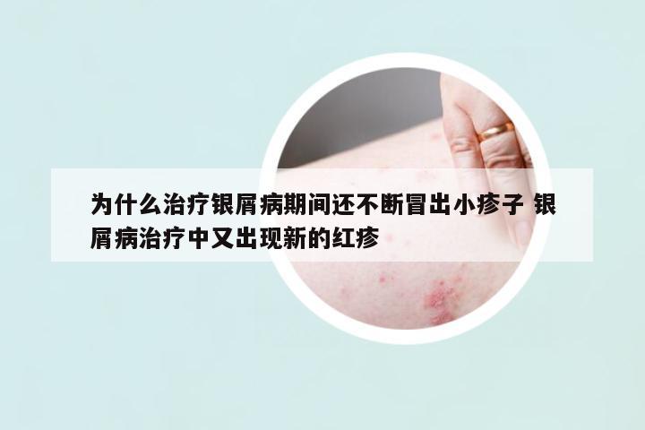 為什么治療銀屑病期間還不斷冒出小疹子 銀屑病治療中又出現(xiàn)新的紅疹