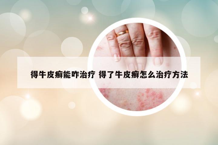 得牛皮癬能咋治療 得了牛皮癬怎么治療方法