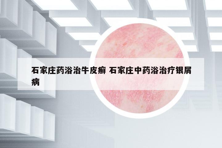 石家莊藥浴治牛皮癬 石家莊中藥浴治療銀屑病