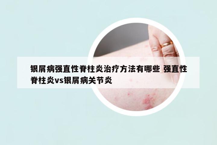 銀屑病強直性脊柱炎治療方法有哪些 強直性脊柱炎vs銀屑病關(guān)節(jié)炎