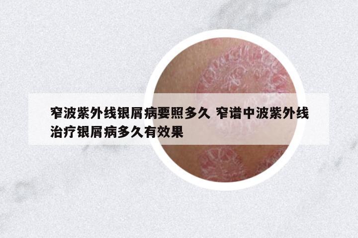 窄波紫外線銀屑病要照多久 窄譜中波紫外線治療銀屑病多久有效果