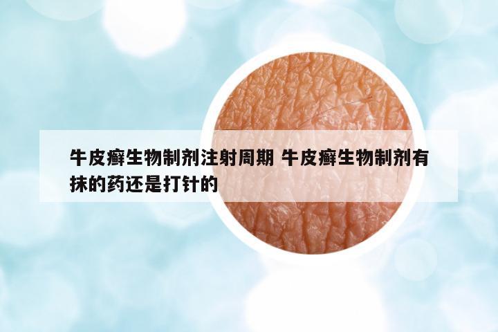牛皮癬生物制劑注射周期 牛皮癬生物制劑有抹的藥還是打針的