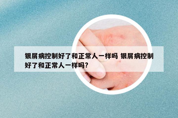 銀屑病控制好了和正常人一樣嗎 銀屑病控制好了和正常人一樣嗎?