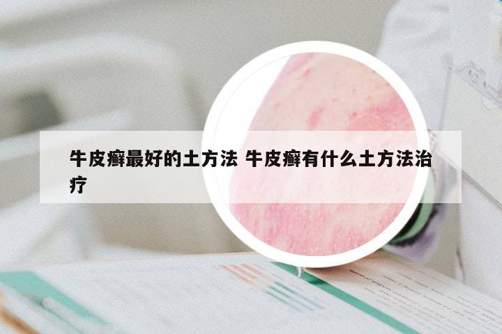 牛皮癬最好的土方法 牛皮癬有什么土方法治療