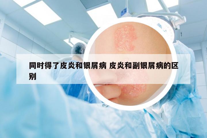 同時(shí)得了皮炎和銀屑病 皮炎和副銀屑病的區(qū)別