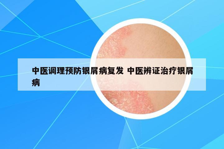 中醫(yī)調(diào)理預(yù)防銀屑病復(fù)發(fā) 中醫(yī)辨證治療銀屑病