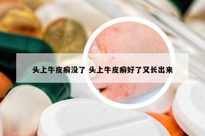 頭上牛皮癬沒了 頭上牛皮癬好了又長出來