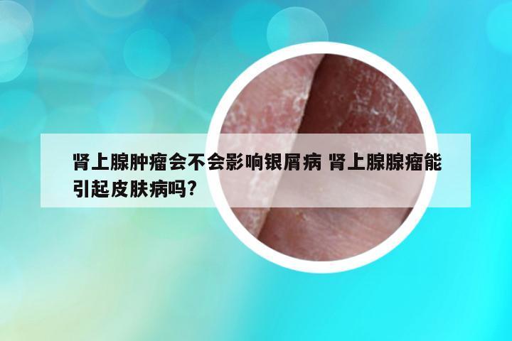 腎上腺腫瘤會(huì)不會(huì)影響銀屑病 腎上腺腺瘤能引起皮膚病嗎?