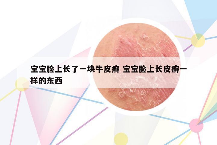 寶寶臉上長(zhǎng)了一塊牛皮癬 寶寶臉上長(zhǎng)皮癬一樣的東西