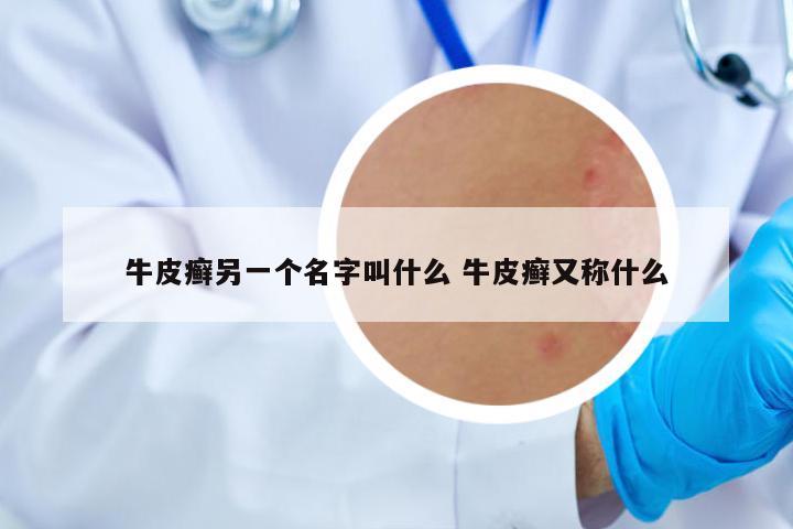 牛皮癬另一個名字叫什么 牛皮癬又稱什么