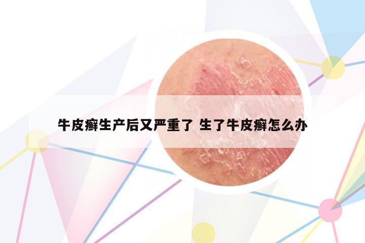 牛皮癬生產(chǎn)后又嚴(yán)重了 生了牛皮癬怎么辦