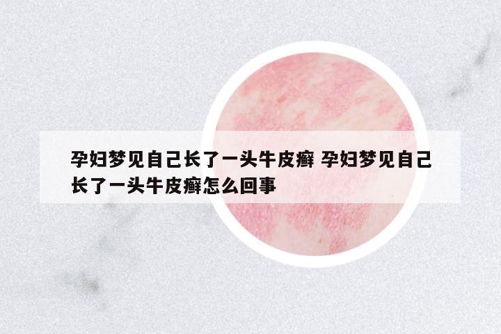 孕婦夢(mèng)見(jiàn)自己長(zhǎng)了一頭牛皮癬 孕婦夢(mèng)見(jiàn)自己長(zhǎng)了一頭牛皮癬怎么回事