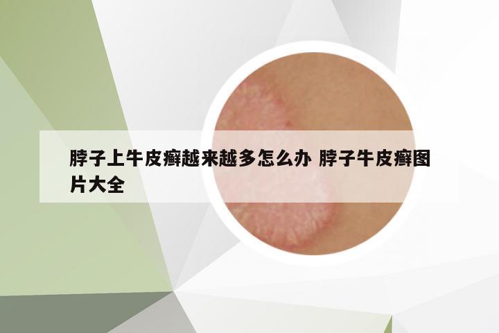 脖子上牛皮癬越來越多怎么辦 脖子牛皮癬圖片大全