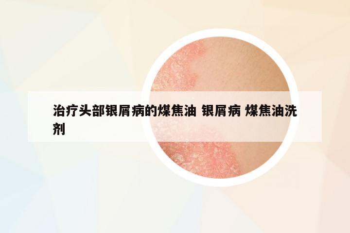 治療頭部銀屑病的煤焦油 銀屑病 煤焦油洗劑