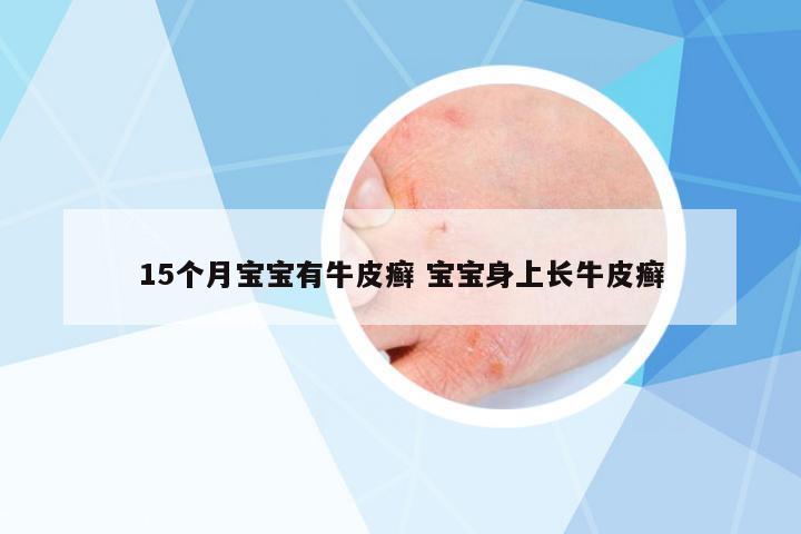 15個月寶寶有牛皮癬 寶寶身上長牛皮癬