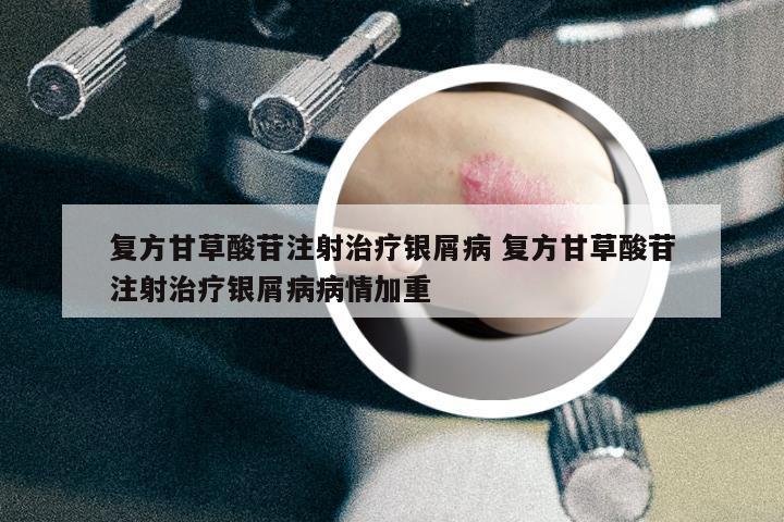 復(fù)方甘草酸苷注射治療銀屑病 復(fù)方甘草酸苷注射治療銀屑病病情加重