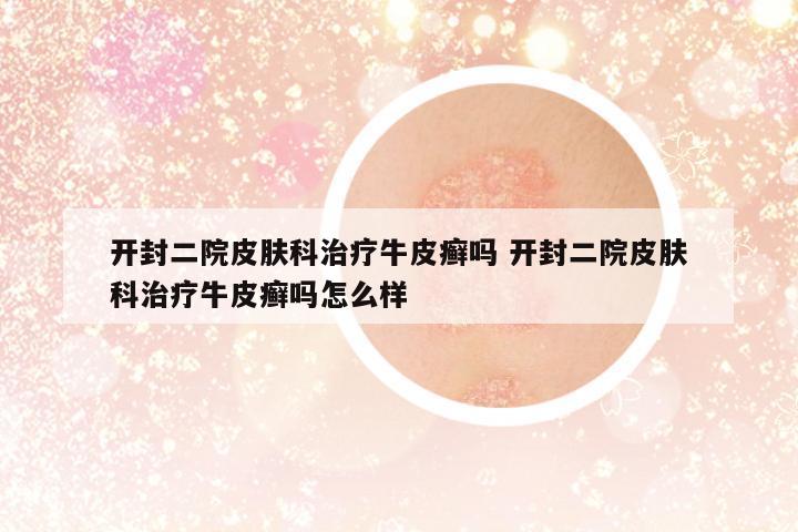 開(kāi)封二院皮膚科治療牛皮癬嗎 開(kāi)封二院皮膚科治療牛皮癬嗎怎么樣