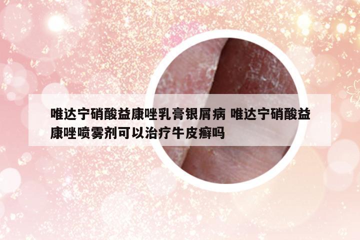 唯達(dá)寧硝酸益康唑乳膏銀屑病 唯達(dá)寧硝酸益康唑噴霧劑可以治療牛皮癬嗎