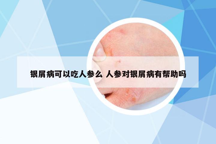 銀屑病可以吃人參么 人參對(duì)銀屑病有幫助嗎