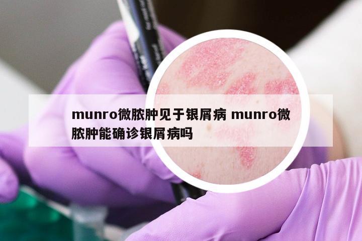 munro微膿腫見于銀屑病 munro微膿腫能確診銀屑病嗎