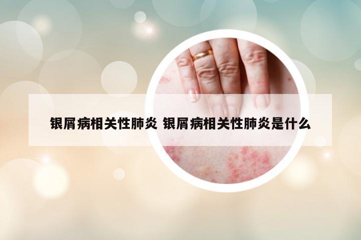 銀屑病相關(guān)性肺炎 銀屑病相關(guān)性肺炎是什么