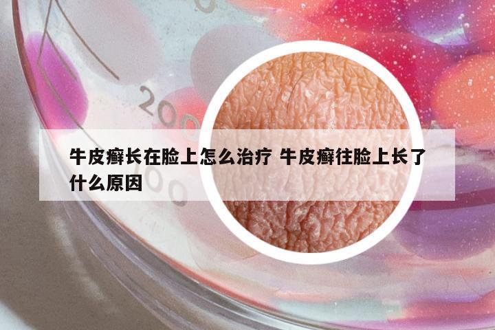 牛皮癬長在臉上怎么治療 牛皮癬往臉上長了什么原因
